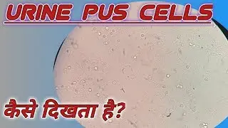 Pus cell under microscope | Pus cell in urine | Pus cell in sperm