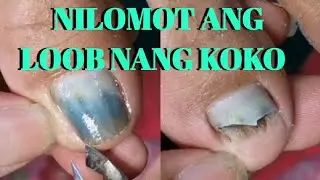 PAG AAYOS SA SIRANG KOKO SA PAA: NAGKALOMOT SA LOOB😲😲