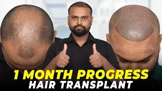 Hair Transplant in Kolkata | Best Results & Cost of Hair Transplant in Kolkata