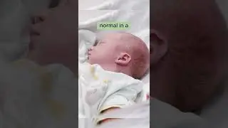 👶🏻Newborn's Head Shape