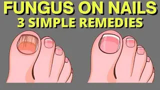 3 Affordable and Natural Tips to Eliminate Nail Fungus
