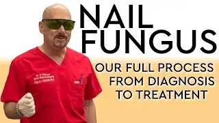 Our Full Nail Fungus Process // Diagnosis to Treatment Options