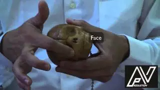 Fetal Skull
