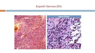 Kaposi's Sarcoma