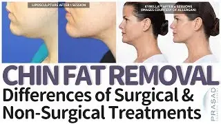 Double Chin Treatment - Pros and Cons of Surgical and Non-Surgical Solutions