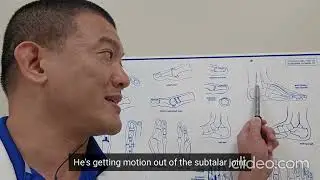 Ankle Fusion Surgery | Dr. Kevin Lam #toppodiatrist #footsurgeon