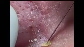 КОМЕДОНЫ НА НОСУ/comedos are on their nose