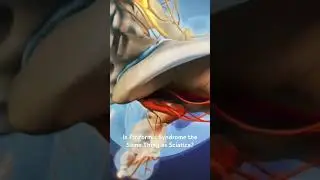 Is Piriformis Syndrome the Same Thing as Sciatica?