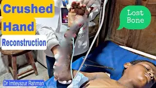 Hand Reconstruction surgery,Hand Injury,Bone Loss,Microsurgery,Hand Rehabilitation