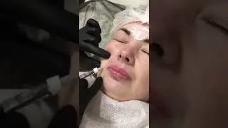 Коррекция носогубных складок