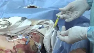Escharotomy Procedures for Burn Patients