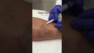 Vein Removal