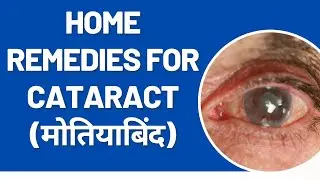 मोतियाबिंद के लिए घरेलू उपचार | Home Remedies for Cataract