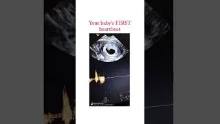 Your Baby’s FIRST Heartbeat on Ultrasound!💓 