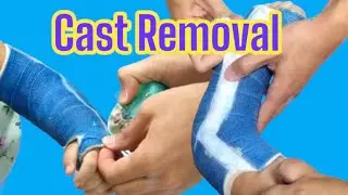 Cast Removal Lovely Girl