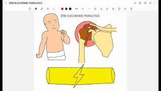 ERB DUCHENNE PARALYSIS | ERB'S PALSY