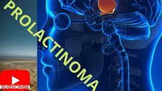 Prolactinoma ▶ Questions For/about Prolactinoma