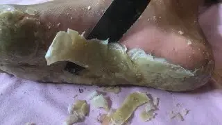 How to removal skin | callus removal skin flakes #38