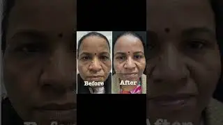 Upper eye lid become lax with ageing . Get it removed with one hour in house procedure !!