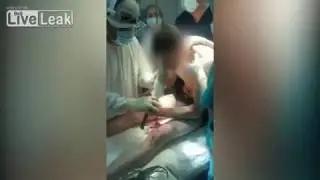 Удаление арматуры из головы