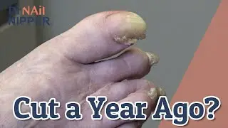 Toenails Cut a Year Ago (2020)