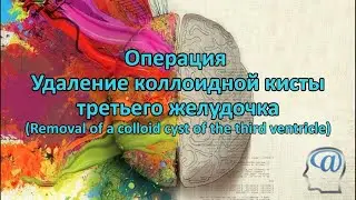 Операция. Удаление коллоидной кисты 3 желудочка. Нейрохирургия. Surgical Treatment of Colloid Cyst