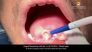 Lingual frenectomy with the the D-Storm™ Diode Laser