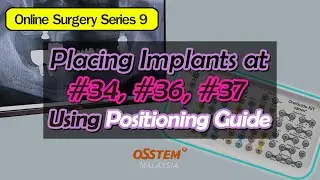 Placing Implants #34, #36, #37 Using Positioning Guide