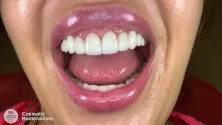 Cosmetic Restorations - Veneers, Gum Lifting and Teeth Reshaping