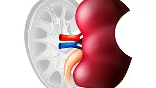 Повторная лапароскопическая резекция левой почки  RENAL 10 (первичная в 2020г).