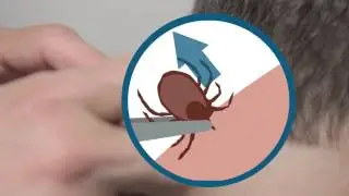 How Do I Remove a Tick?