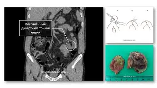 Дивертикулит тонкой кишки. Лапароскопическое удаление дивертикула тонкой кишки.