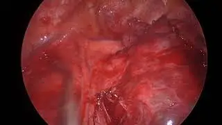 Uniportal VATS bullectomy in Left upper lobe CCAM