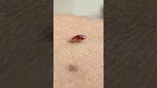 Bed Bug Bite!