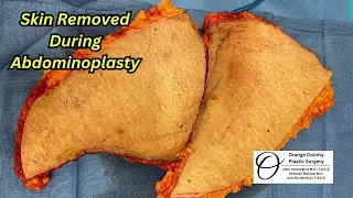 Skin Removed During Tummy Tuck | Orange County Plastic Surgery #tummytuck #plasticsurgeryresults