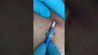 İltihaplı svk videosu