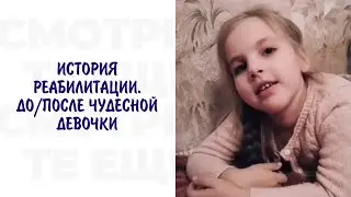 Результаты реабилитации. ДО/ПОСЛЕ ЧУДЕСНОЙ ДЕВОЧКИ