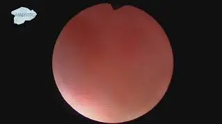 Access into tight Ureteral Orifices