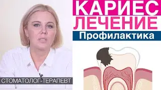 Кариес - основные методы лечения без сверления, со сверлением. Профилактика кариеса. Метод Icon