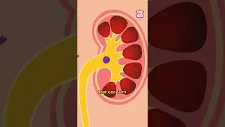 What Causes Kidney Stones? | World Kidney Day Special 
