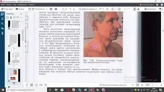 284 Гипокортицизм