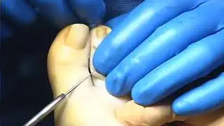 BioPro Digital Compression Screw
