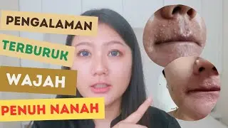 Dermatitis Perioral - Personal Experience of Pus-filled Facial Skin | My Acne Journey