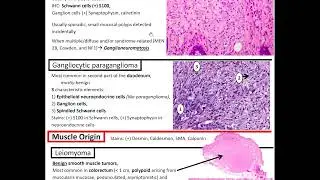 Mesencyhmal Tumors of the GI Tract: Kurt's Notes #pathagonia