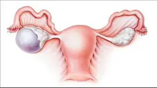 Healing Ovarian Cyst Binaural Beats Music | Reduce Ovarian Cyst Pain | Healing Meditation