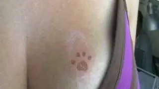 Allergic reaction to Black Henna tattoo before treatment