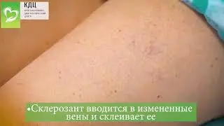 А у вас тоже есть сеточки на ногах?🌼 Поможем убрать!