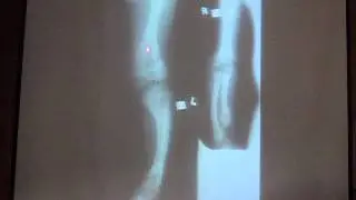 foot tumors