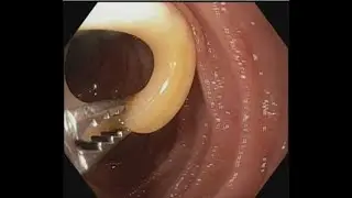 Ascariasis Removal from papilla 