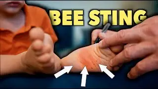 BEE STING ON BOTTOM OF HIS FOOT... It Started to Swell!  (What All Parents Need to Watch Out For)